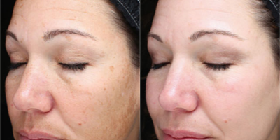 25-34 year old woman treated with BroadBand Light (BBL) - BroadBand Light (BBL) before and after