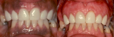 25-34 year old woman treated with Gum Lift - This patient didnt like her dark spots or pigmentation on her gums. Painlessly removed permanently with a laser.