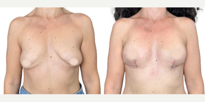 35-44 year old woman treated with Breast Reconstruction - Breast reconstruction in Colombia is a way to improve the results of previous procedures by adding volume, shape, and lift to the breasts using the patients tissue. Dr. Alan repositions tissue to create the new breast shape. This procedure forms a natural-looking and feeling breast mound with results that last a lifetime.In some cases, breast reconstruction alone doesnt provide sufficient volume in the breasts.  Patients wishing additional fullness can return for adipose tissue or fat grafting. These procedures work best when performed at least six months after the initial breast construction to achieve the highest survival rate for the fat graft and the lowest risk of complications.