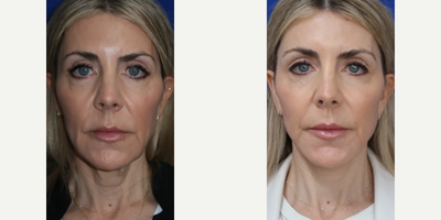 55-64 year old woman treated with Facelift, Neck Lift, Lip Lift - Before and after with the FACEology LIFT!Our 57-year-old female client is just 1 month post-op and the results are incredible!The FACEology Lift is Dr. Lee's signature Deep Plane Facelift technique, designed to deliver the most natural and remarkable results.