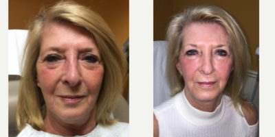 55-64 year old woman treated with Pearl Laser - This patient was interested in non-surgical facial rejuvenation. She underwent laser resurfacing and volume augmentation with Sculptra. She is shown here 1 month after the Pearl Laser treatment. There is an&nbsp;transformation of tired appearance of the face to a more rejuvenated appearance.&nbsp;