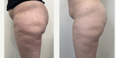 25-34 year old woman treated with Aveli - This patient was looking for improvement of the dimpled skin in her buttock and upper lateral thigh areas. The procedure was done awake with local anesthesia and took under 1 hour to perform. The post procedure photos are 2 months following the procedure.