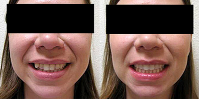 Invisalign - Invisalign