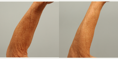 62 year old woman treated left arm with microneedling and DefenAge  post-treatment serum - 62 year old with severe sun damage of the arms due to chronic sun exposure. She was treated with a single session using the ProCell device with a 0.5 mm tip. Post-treatment moisturization with DefenAge serum was performed at 10 minutes, thirty minutes, and one hour post-treatment. DefenAge serum has protein signaling agents, or defensins, that stimulate your own quiescent stem cells to respond to an imagined injury. The new collagen produced gives the appearance of rejuvenated and rehydrated skin. Usually multiple treatments with microneedling are required to produce any significant result. With the addition of DefenAge for post care, the number of treatments is reduced. Remarkably, there was no temporary deformity nor down time with this treatment.
