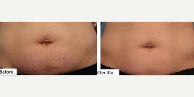 35-44 year old woman treated with Secret RF - After photo was taken 3 months after the 3rd treatment.