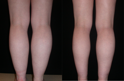 Ankle Liposuction - This very athletic young woman had had excess fat in her lower legs for years, very much out of proportion with the rest of her frame. I performed liposculpture of the calves and ankles to not only remove excess fat but to contour the area as well, to create more shapely and defined legs, as seen in her postop photo taken 6 weeks after her procedure.