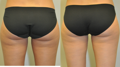 28 year old woman treated with CoolSculpting - 28 year old female 3 months after CoolSculpting of the inner thighs.