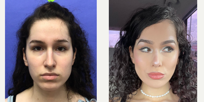 Patient treated with Cheek Augmentation, Facial Feminization Surgery, Rhinoplasty, Septoplasty, Transgender Facial Feminization  - 18 to 24 year-old female patient is 9 months post-op from Facial Feminization surgery. Her procedures included: Forehead Lift, Hairline Lowering, Orbital Bony Contouring, Septorhinoplasty (closed) with Cartilage Grafts, Cheek Implants (small), Chin Implant (central) with Reduction and Contour, Soft Tissue to Nasolabial Folds, Intranasal Lip Lift with Fascia to Lips and 300 Micrografts.