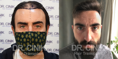 25-34 year old man treated with FUE Hair Transplant - Sapphire FUE hair transplant results, 11 months later, are seen below. The Norwood-5 baldness of our patient needed the transplantation of 4250 grafts.