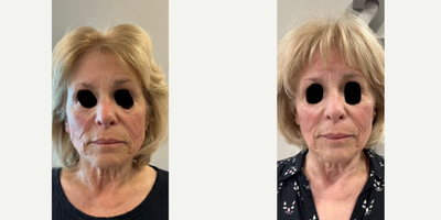 65-74 year old woman treated with Emface - This is a before and after of an Emface treatment. You can see improved skin texture of the cheeks and lower face. Wrinkle depth has lessened, and cheek volume has improved with a slight lifting. This patient has undergone 6 treatments at this point and we are waiting 3 months for optimal results.