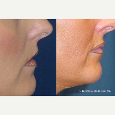 Lip Augmentation - Lip Augmentation