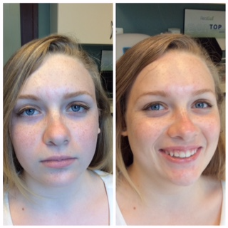 18-24 year old woman treated with HydraFacial - HydraFacial