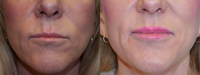 50-59 year old woman treated with Lip Implants - 50-59 year old woman treated with Lip Implants