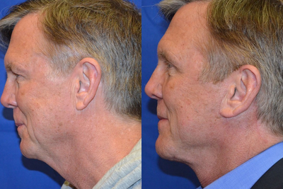 Man treated with Neck Lift - Man treated with Neck Lift