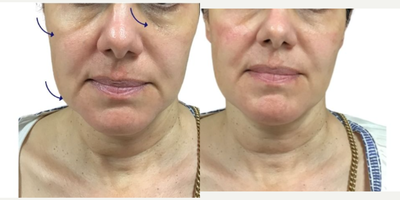 45-54 year old woman treated with Aquagold, Facial - REVIVIFY TREATMENT USING AQUAGOLD FINE TOUCH