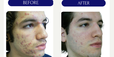 17 or under year old man treated with LaserACNE TREATMENT - LASER ACNE TREATMENT