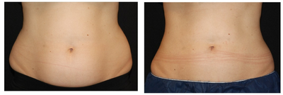 CoolSculpting - 
	CoolSculpting before &amp; after - a single session
