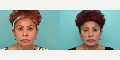 55-64 year old woman treated with Facelift Revision, Facial Fat Transfer - This beautiful patient had a previous facelift many years ago, and she was unhappy with some loss of volume in her cheeks, temples and early drooping of her face and neck. A revision mini-facelift with fat grafting was performed to bring years back to her face, yet keeping it very natural for her.