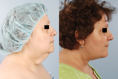 Facelift / necklift by Dr. Brett Kotlus - Lower facelift (necklift) improves the lower midface, jowls, and neck. This patient had full lower facelift with platysmaplasty and resection of subplatysmal fat. A high-SMAS flap technique was used to elevate the deep face tissues with redraping of the overlying skin.
A natural facelift avoids the following: pixie ear deformity, neck hairline step-off, elevated sideburn, blunting of the tragus, and windswept look.