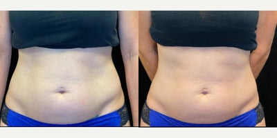 45-54 year old woman treated with Evolve, Semaglutide - Treated with Evolve and Semaglutide. Patient active but wanted to help waistline.