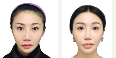 35-44 year old woman treated with Revision Rhinoplasty, Asian Rhinoplasty - Revision rhinoplasty with exchange of L-shaped silicone implant to I-shaped and cartilage graft.
