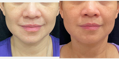 55-64 year old woman treated with Genius - Genius RF microneedling 1 session showing improvement of nasolabial folds