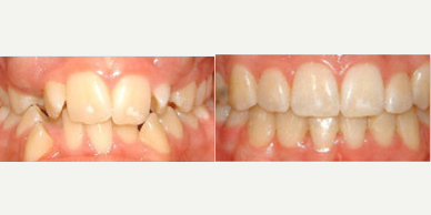 25-34 year old man treated with Damon Braces - patient also used AcceleDent to decrease treatment time