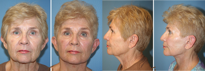 Natural Lower Facelift and Fat Grafting  - At 71 years old this patient's primary complain was her aging face and neck. &nbsp;She was unhappy with the loose skin and extra laxity in her face, jowls and neck area. &nbsp;She was recommended to Dr. Kevin Sadati by a close friend who had a mini lift with him. &nbsp;As a board certified facial plastic and reconstructive surgeon Dr. Kevin Sadati recommended his Natural Facelift to the patient in combination with fat grafting. Dr. Kevin Sadati's technique uses his self developed muscle tightening technique to create even tension on the skin and natural looking facelift results. &nbsp;This patient also received fat grafting to the face mixed with PRP (Platelet Rich Plasma) to ensure the fat survival. &nbsp;