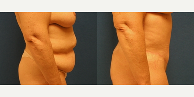 45-54 year old woman treated with Mommy Makeover - One of the components of this 49-year-old woman's Mommy Makeover was a tummy tuck at our Sacramento practice. Dr. Yamahata removed excess skin and fat for a beautiful new abdomen that blends well with her enhanced breasts.