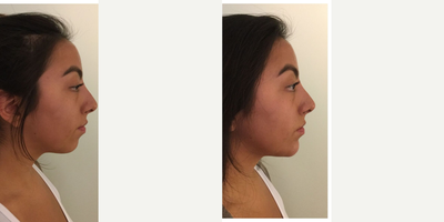 18-24 year old woman treated with Restylane Lyft - This younger female patient wanted a chin that was more symmetrical for her face shape. Dr. Rivkin used Restylane Lyft - A strong long lasting filler that stays in place. He strategically places it in the chin area so that the chin is more aligned with the upper lip and forehead. This creates a more symmetrical face shape while remaining natural and subtle.
