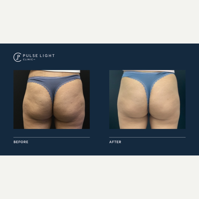 35-44 year old woman treated with Velashape - 25-34 year old woman treated with Velashape 3 on buttocks / bum