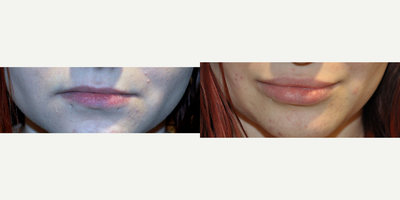25-34 year old woman treated with Lip Implants - Silicone lip implants placed under local anesthesia. 5mm bottom lip implant and 4mm top lip implant. These soft silicone implants feel and look natural.
