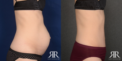 Woman treated with Tummy Tuck - Woman treated with Tummy Tuck