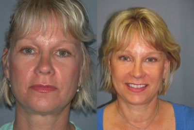 50 year old Female Blue Peel and Lite Lift - 	Blue Peel and Lite Lift on 50 year old