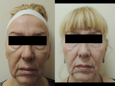Facial Rejuvenation - 
	Plasma skin regeneration (PSR), is a non-laser treatment for Facial Rejuvenation.
