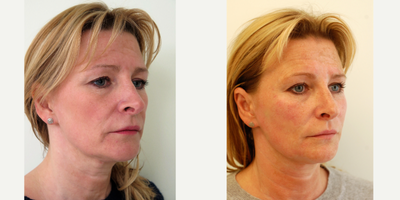 55-64 year old woman treated with Ellanse for facial rejuvenation - By the time most women reach their 50's they have lost up to 50% of the collagen in the skin leading to laxity and descent of the facial tissues leading to the formation of the naso-labial and marionette folds, the jowls and loss of jawline contour and upper neck laxity. All of these problems can be addressed by using Ellanse which is a collagen stimulator restoring loss volume and improving skin collagen through bio-stimulation. The results are long lasting and Ellanse is a real alternative to traditional dermal fillers.
