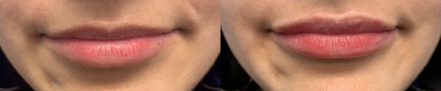 Woman treated with Lip Augmentation - Woman treated with Lip Augmentation using 1 syringe of lip filler.
