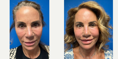 64 year old woman treated with revision deep plane facelift, revision necklift, revision upper eyelid lift, deep chemical peel,  - 64 year old woman treated with revision deep plane facelift (two prior surgeries by unknown surgeons), revision neck-lift (one prior with unknown surgeon), upper eyelid lift revision (one prior with unknown surgeon), deep chemical peel, facial fat grafting revision (one prior with unknown surgeon), lip lift