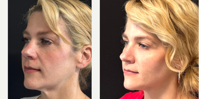 25-34 year old woman treated with Restylane Contour - Experience the transformative effect of midface fillers  because you deserve to feel your best!