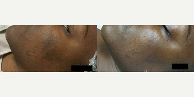 Woman treated with Dermaplaning - Woman treated with Dermaplaning