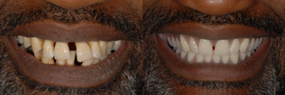 This male patient had replacement of all his teeth with full denture in the top jaw and implant  bridge in the bottom jaw.   - 
	This patient presented with severe form of gum disease around his teeth. After discussing different treatment options patient decided to have a full denture in the top jaw and implant supported bridge in the bottom jaw. In the intial stage of treatment records were collected and immediate dentures were fabricated. On the surgery day all teeth were removed, implants were placed in the lower jaw and new teeth were delivered to the patient. After appropriate healing time a permanent bridge was fabricated for the lower jaw. Patient requested to have a distema between his top front teeth.
