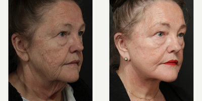 Woman treated with Facelift - Woman treated with Facelift