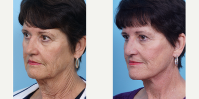 55-64 year old woman treated with Facelift - This patient in her 60's was concerned with the laxity and folding of her neck skin and overall tired look. She wanted to look refreshed. She had a facelift to elevate the structures of her neck. Note the decrease wrinkling of her neck and the decrease in hanging jowl.