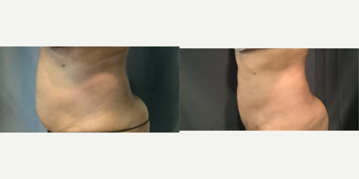 45-54 year old woman treated with Laser Liposuction - laser liposuction of abdomen
