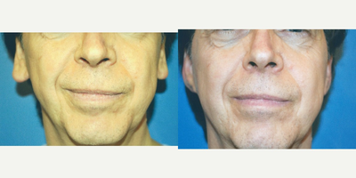  Ear Lobe Surgery - Patient did not like how his ear lobes protruded. An earlobe reduction was performed to enhance the shape of the lobe and minimize the protrusion.&nbsp;