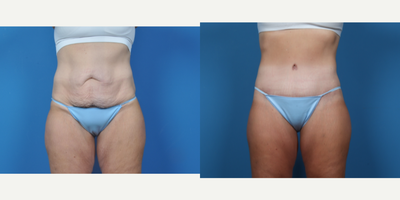45-54 year old woman treated with Breast Augmentation, Liposuction, Mommy Makeover, Tummy Tuck - CIRCUMFERENTIAL ABDOMINOPLASTY. BILATERAL BREAST AUGMENTATION WITH VERTICAL MASTOPEXY