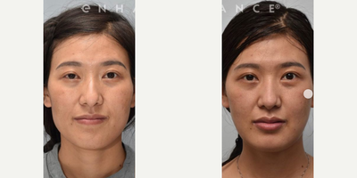 Woman treated with Cheekbone Reduction - Woman treated with Cheekbone Reduction