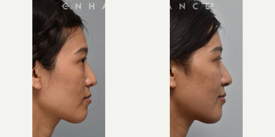 Woman treated with Cheekbone Reduction - Woman treated with Cheekbone Reduction