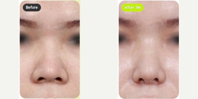 25-34 year old woman treated with Alarplasty - 25-34 year old woman treated with Alarplasty