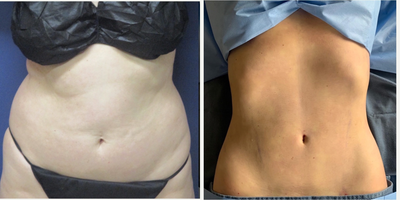 45-54 year old woman treated with Abdominal Etching - Age: 46yFHeight: 57Weight: 158 poundsBMI: 25Fat removed: 1850ccAreas Treated: Upper Abdomen, Lower Abdomen, Waist, Back Bra Rolls, and Upper BackGoals: after her last baby she lost steam for working out, and is perimenopausal, gained 20 poundsTime after Surgery: Intraop